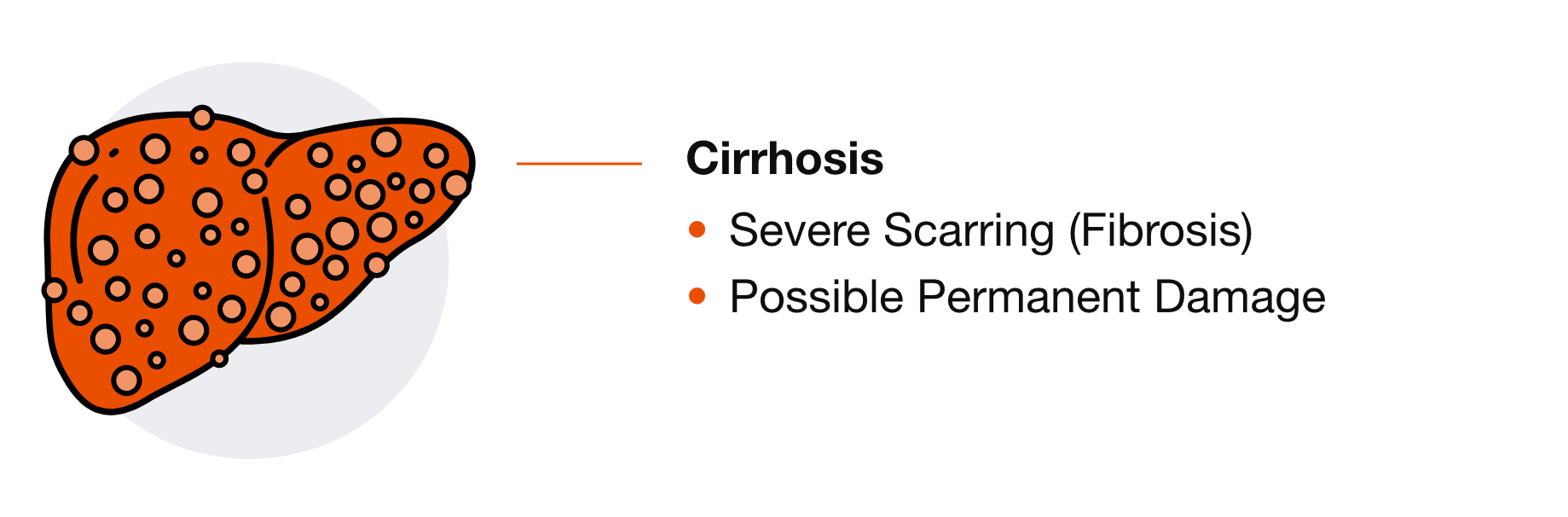 Cirrhosis: Severe Scarring (Fibrosis) and Possible Permanent Damage