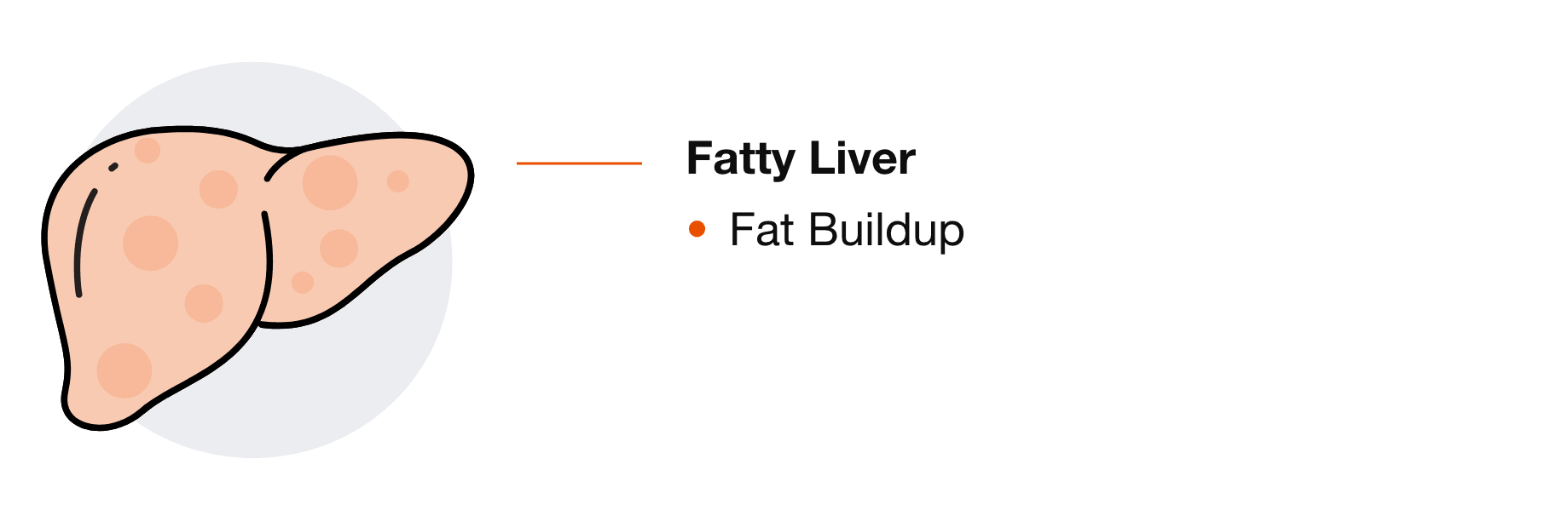 Fatty Liver: Fat Buildup